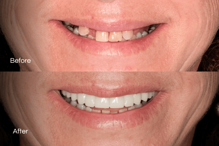 Two close-up mouth photographs arranged vertically.
