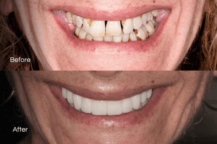 Two close-up mouth photographs arranged vertically.