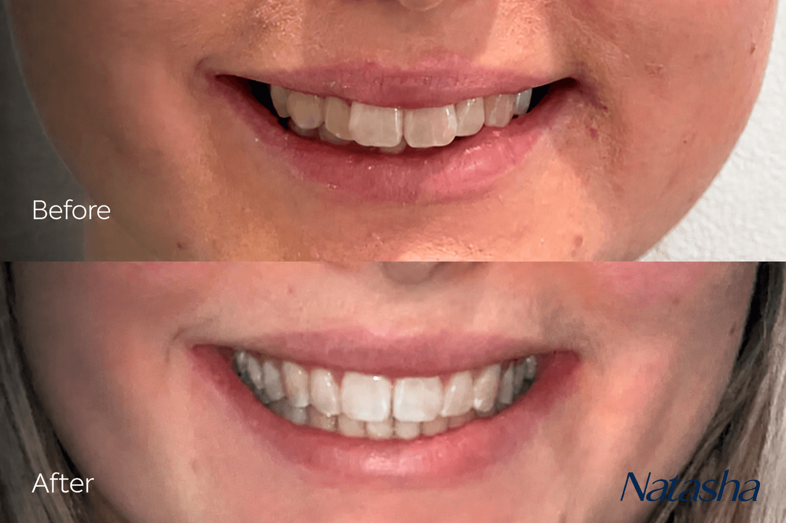 Two close-up mouth photographs arranged vertically.