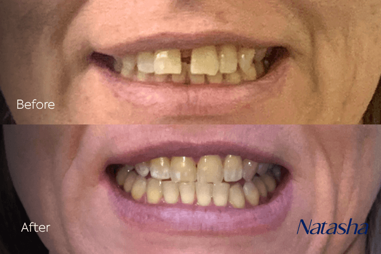 Two close-up mouth photographs arranged vertically.