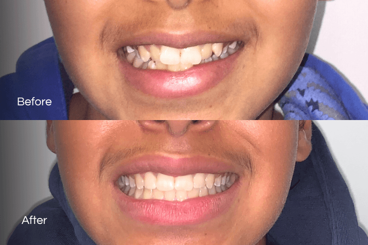 Two close-up mouth photographs arranged vertically.