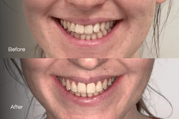 Two close-up mouth photographs arranged vertically.