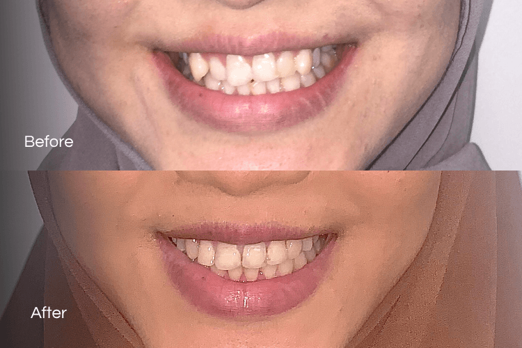 Two close-up mouth photographs arranged vertically.