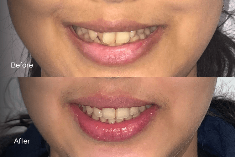 Two close-up mouth photographs arranged vertically.