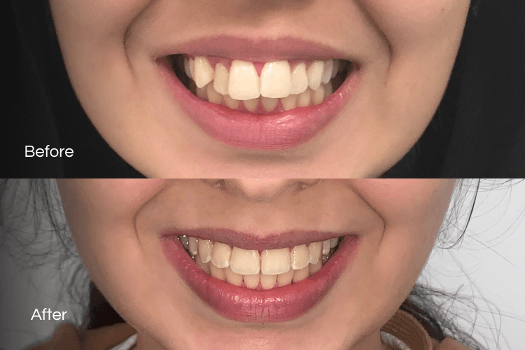 Two close-up mouth photographs arranged vertically.