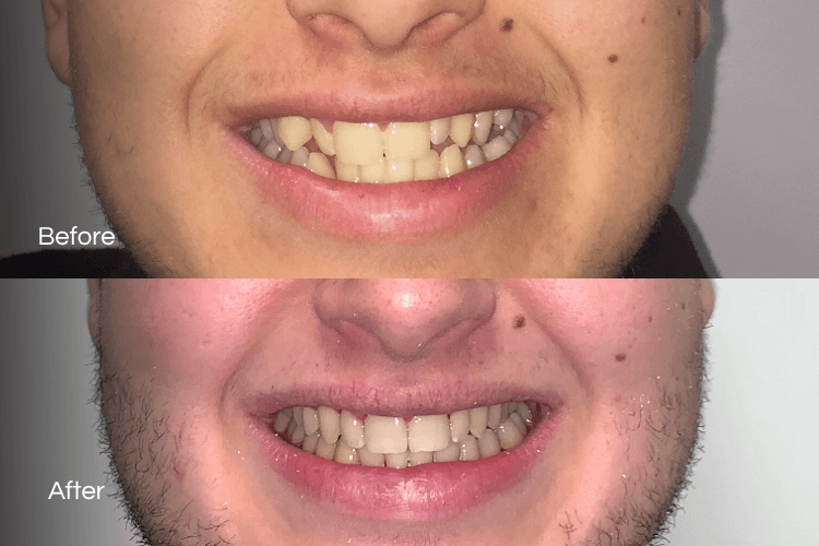Two close-up mouth photographs arranged vertically.