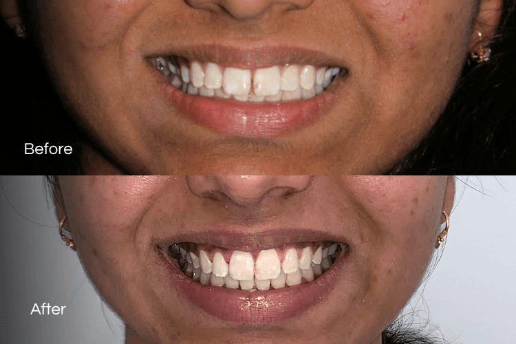 Two close-up mouth photographs arranged vertically.