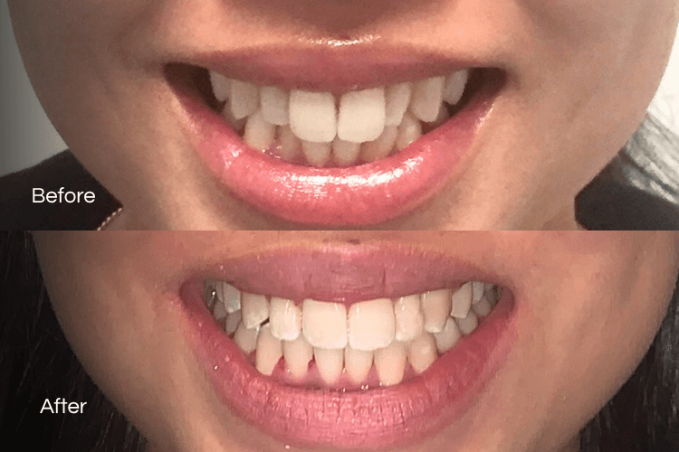 Two close-up mouth photographs arranged vertically.