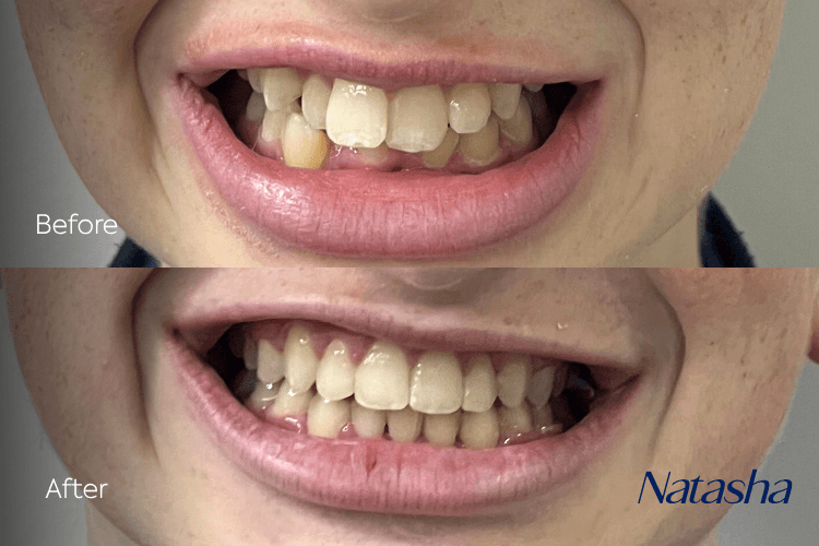 Two close-up mouth photographs arranged vertically.
