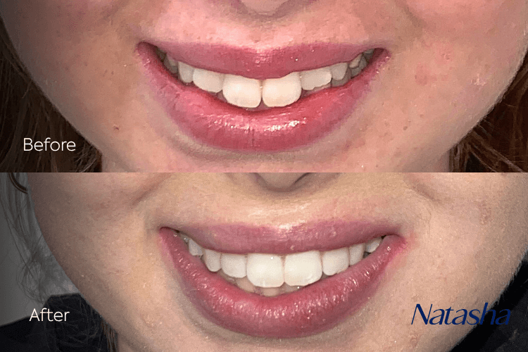 Two close-up mouth photographs arranged vertically.