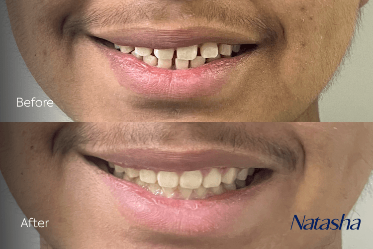 Two close-up mouth photographs arranged vertically.