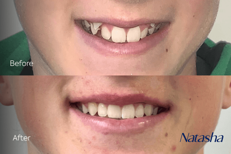 Two close-up mouth photographs arranged vertically.