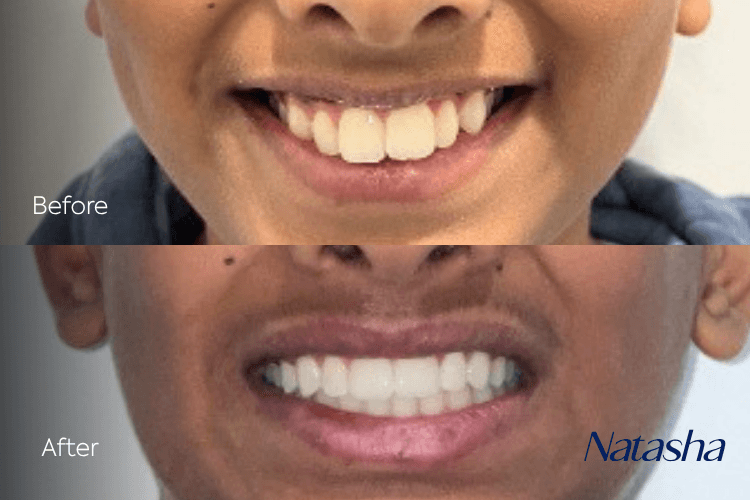 Two close-up mouth photographs arranged vertically.