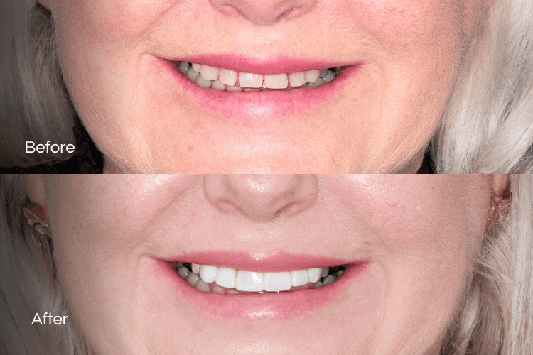 Two close-up mouth photographs arranged vertically.