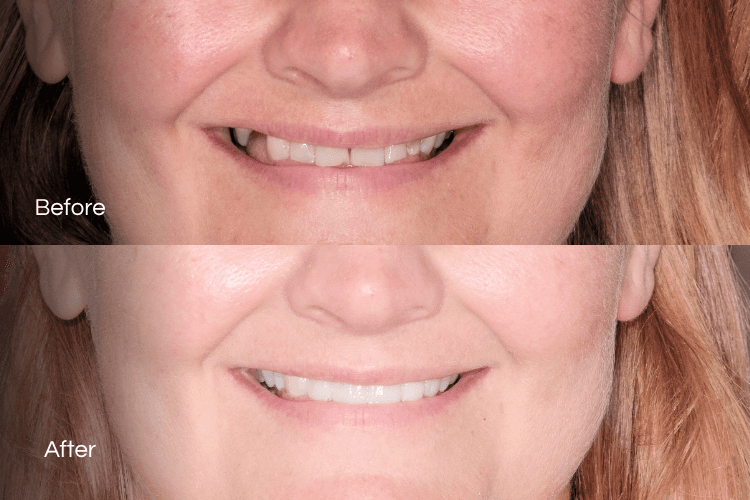 Two close-up mouth photographs arranged vertically.
