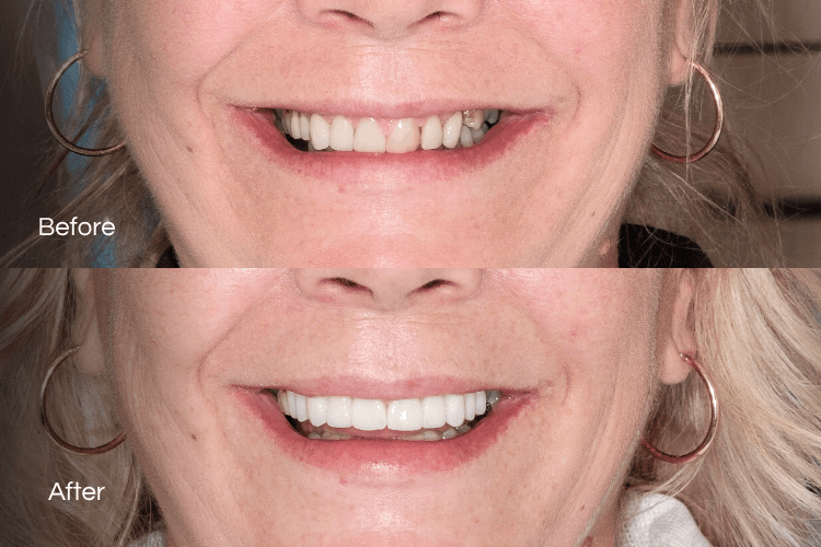 Two close-up mouth photographs arranged vertically.