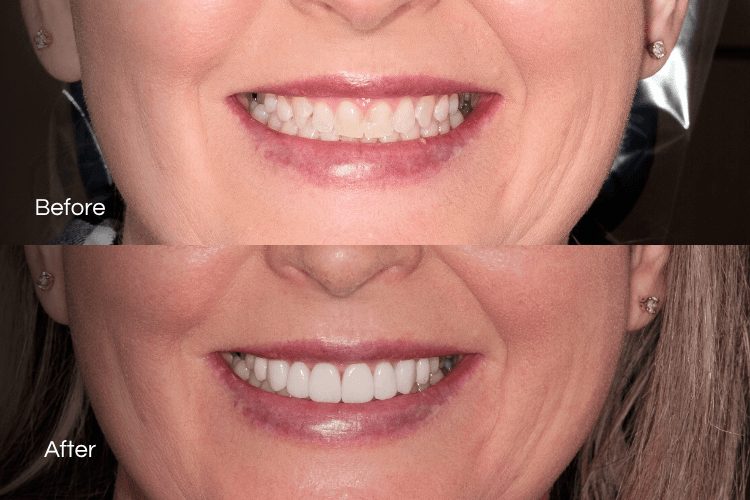 Two close-up mouth photographs arranged vertically.