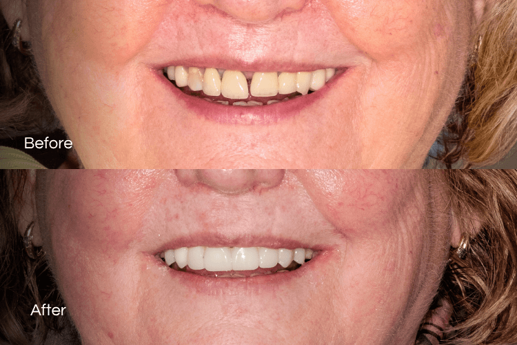 Two close-up mouth photographs arranged vertically.