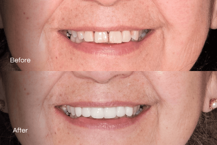 Two close-up mouth photographs arranged vertically.