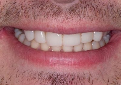 Composite Veneers After