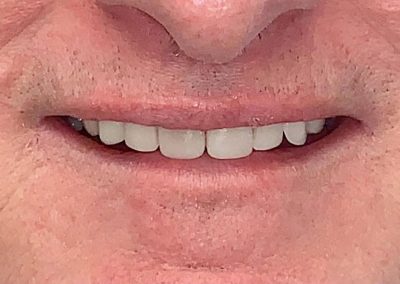 Crowns and Bridge, Veneers combined with Implants