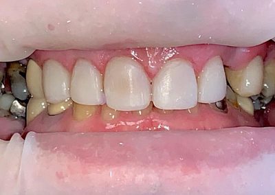 Crowns and Bridge, Veneers combined with Implants