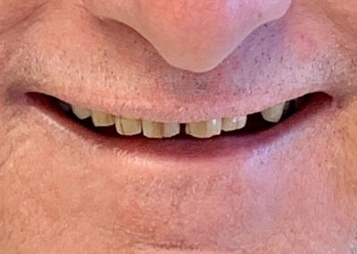 Crowns and Bridge, Veneers combined with Implants