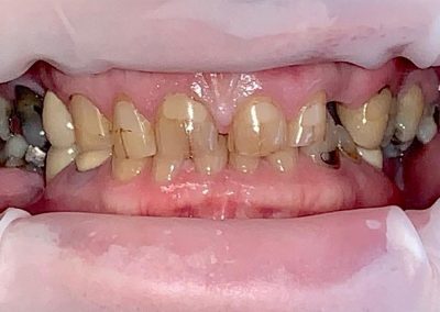 Crowns and Bridge, Veneers combined with Implants