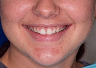 Orthodontics Before