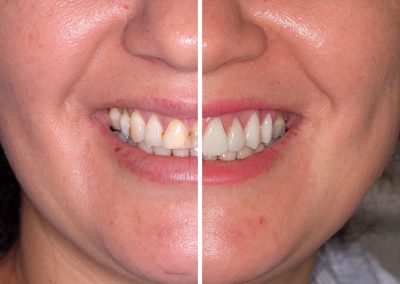 Veneers Before and After