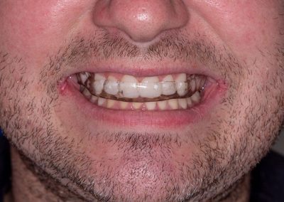 Composite Veneers