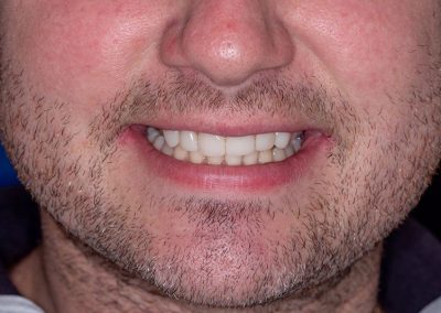 Composite Veneers