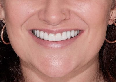 Smile Makeover After