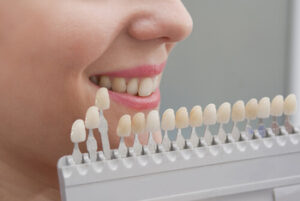 what are veneers teeth colour