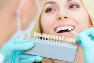 How Much Do Veneers cost in bali colour dapto