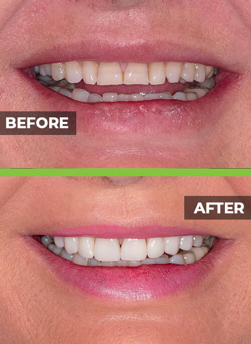 before-after-veneers2.jpg