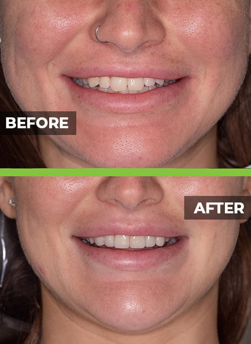 before-after-veneers3.jpg