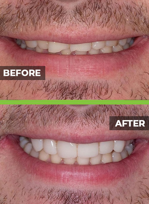 before-after-veneers5.jpg