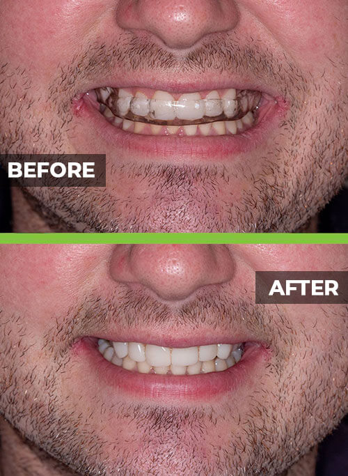 before-after-veneers6.jpg